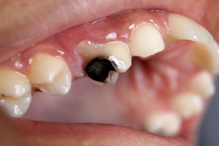 When Does a Tooth Need to Be Extracted?